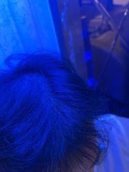 -碧莲盛·不剃发植发