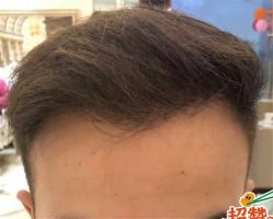 -大麦微针植发全国连锁