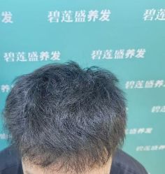 -碧莲盛·不剃发植发