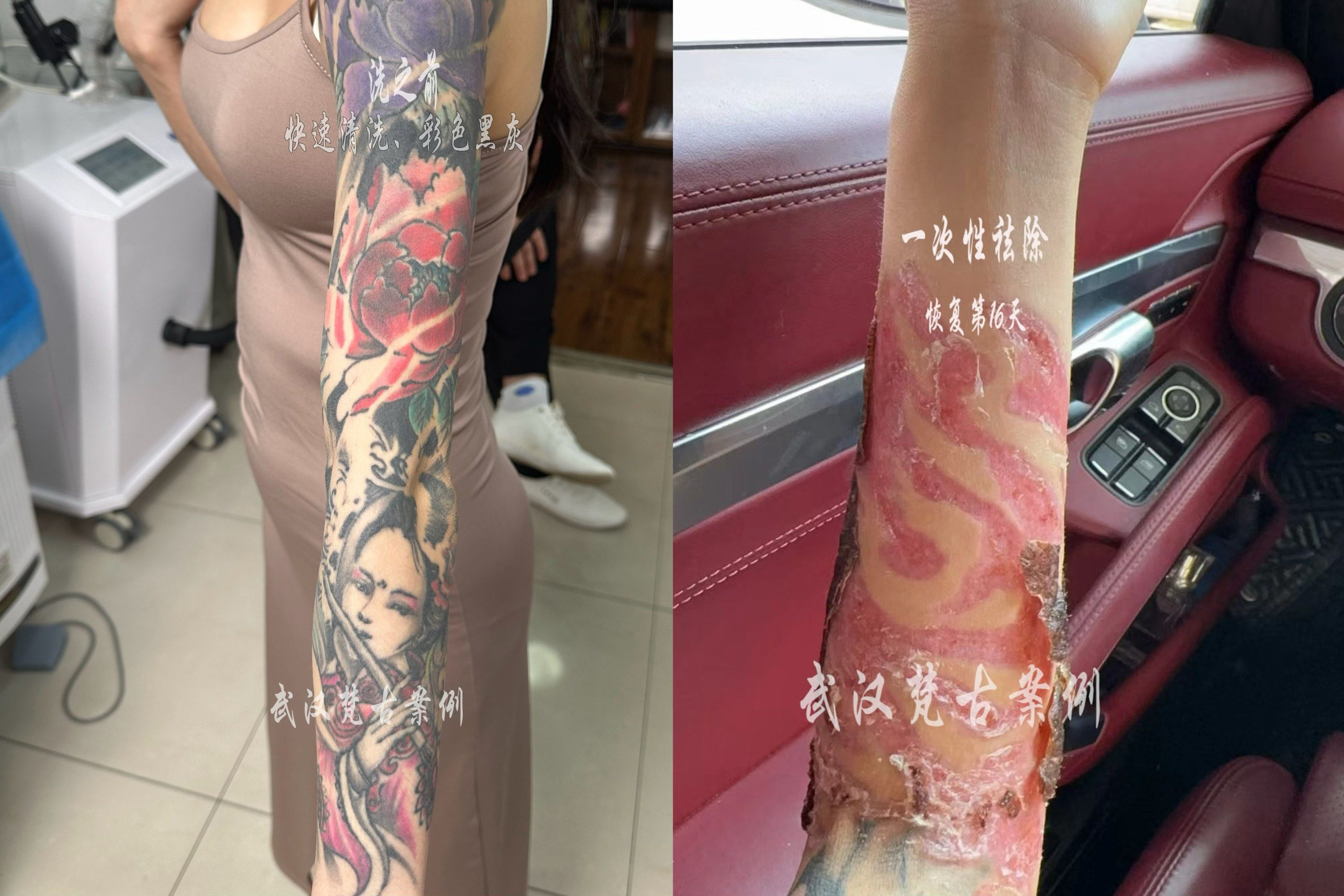 花臂一次性清洗