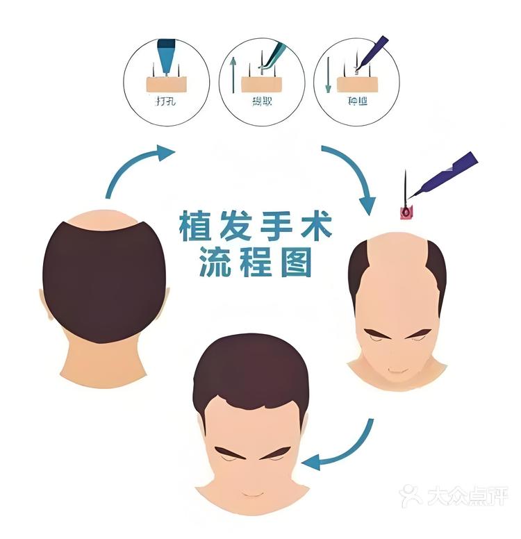 大麦植发团队(大麦植发 ipo)