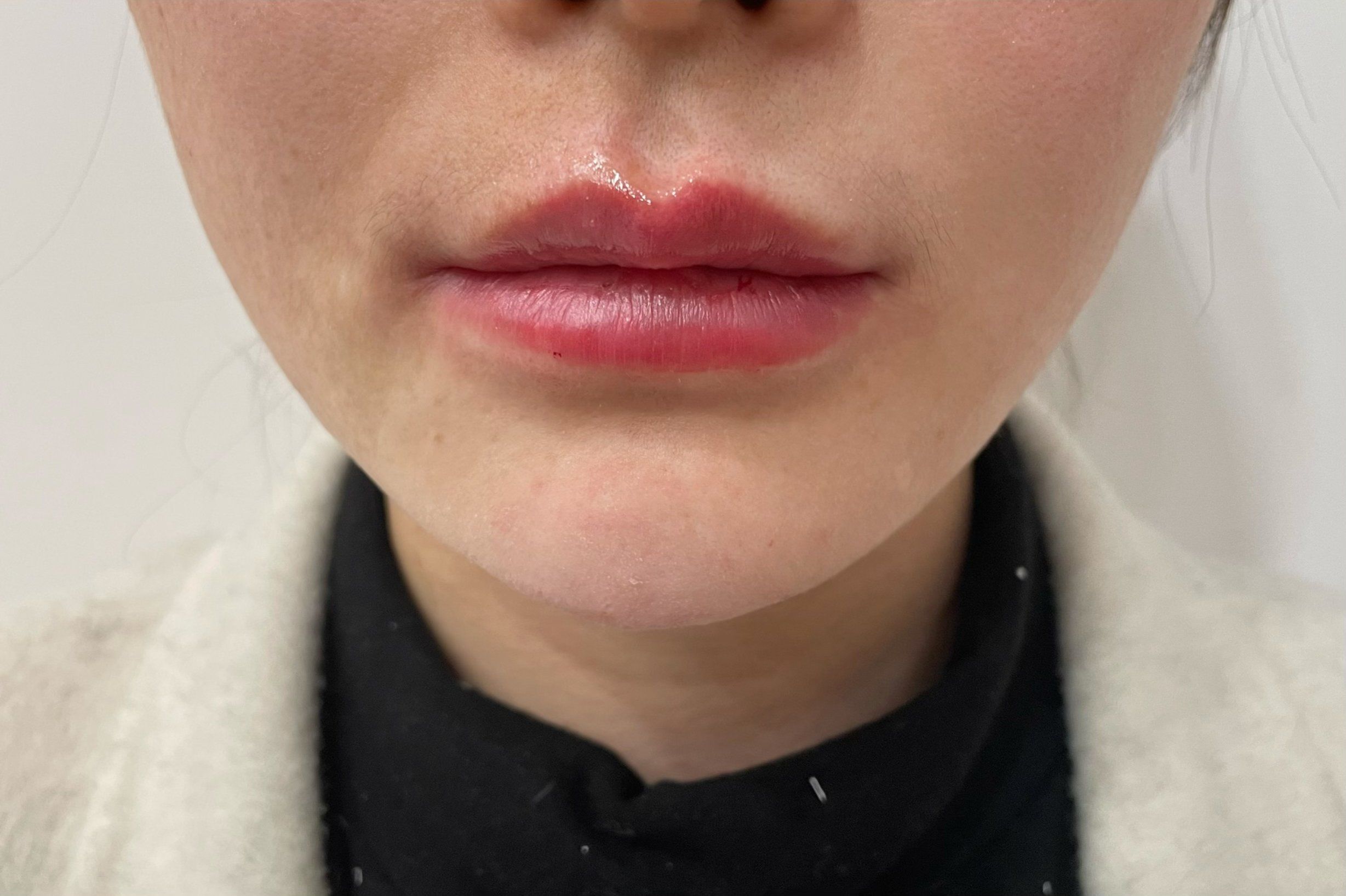 法思丽玻尿酸垫下巴术后当天效果分享