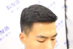 -大麦微针植发丨全国连锁