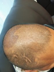 -碧莲盛·不剃发植发