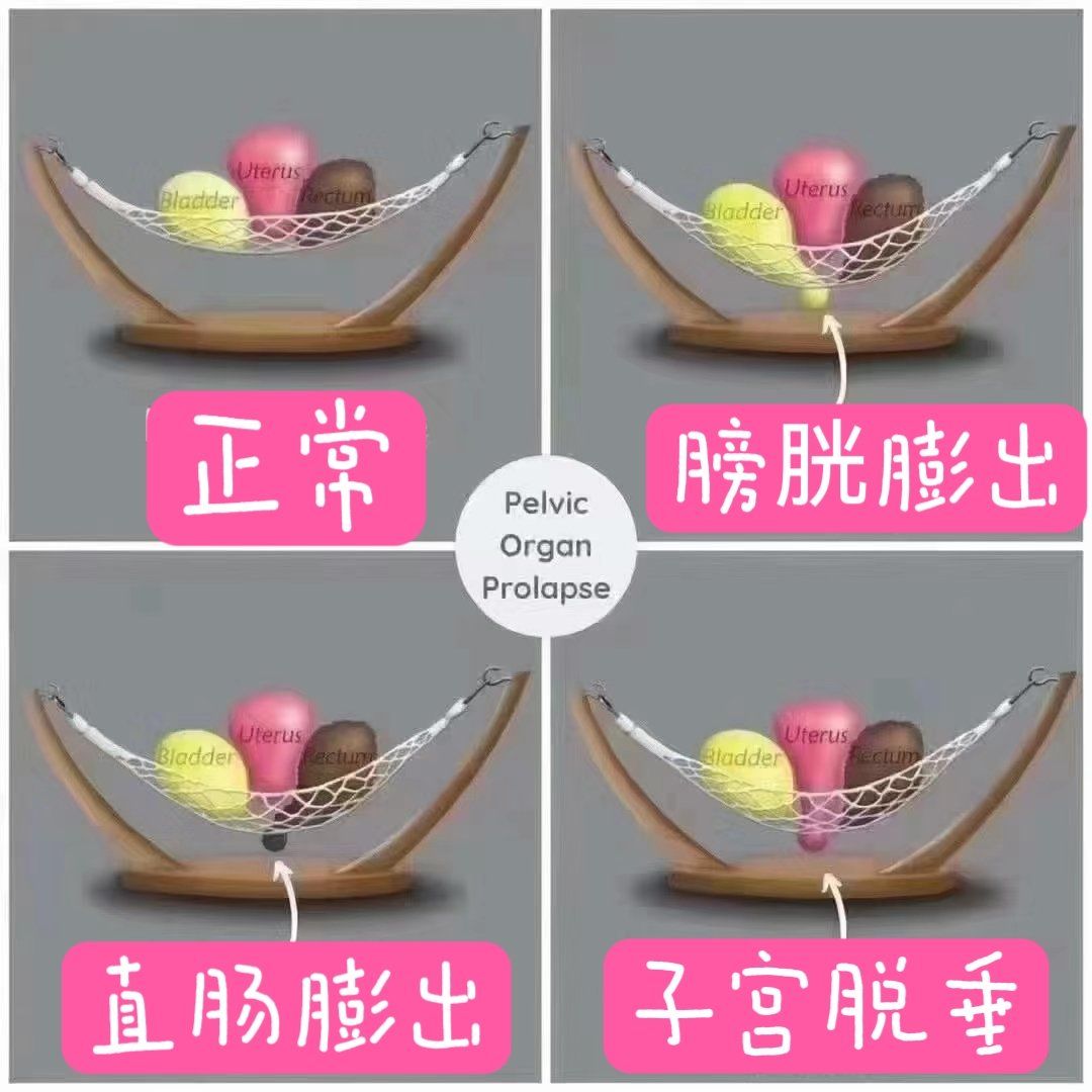 改变膀胱颈的角度,从而影响盆底肌群功能的协调性