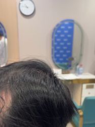 -碧莲盛不剃发植发