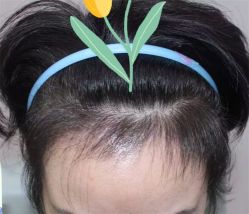 点击看大图 -大麦微针植发全国连锁