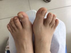 -德哥灰指甲脚气甲沟炎跖疣护理