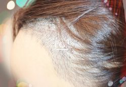 -大麦微针植发全国连锁