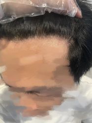 -大麦微针植发全国连锁