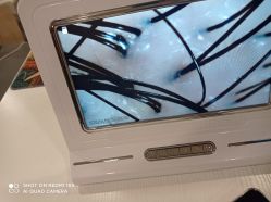 -碧莲盛·不剃发植发