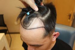 -大麦微针植发丨全国连锁