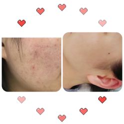 -痘博士烟台·全国连锁祛痘机构