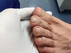 -Andrew指甲专科灰指甲·甲沟炎矫正·3D步态矫形鞋垫定制(上海法华镇路旗舰店)