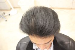 点击看大图 -大麦微针植发丨全国连锁