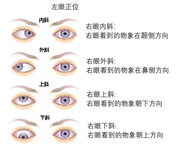 为什么会斜视小孩为什么在线