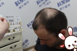 点击看大图 -大麦微针植发丨全国连锁