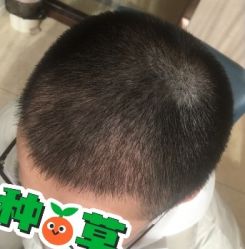 -大麦微针植发丨全国连锁