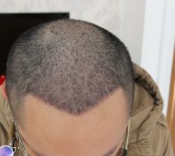 -大麦微针植发丨全国连锁