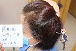 -大麦微针植发丨全国连锁