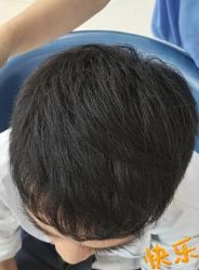 -大麦微针植发丨全国连锁