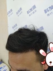 -大麦微针植发丨全国连锁