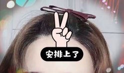 -大麦微针植发全国连锁