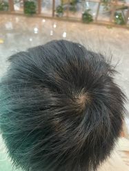 -碧莲盛·不剃发植发