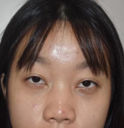 体验后-广州健丽·去眼袋医疗美容机构