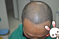 点击看大图 -大麦微针植发丨全国连锁