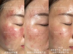 -倩极·精研痘敏肌管理