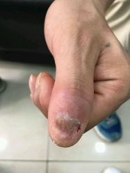 点击看大图 -德哥灰指甲脚气甲沟炎跖疣护理
