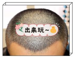 -大麦微针植发全国连锁
