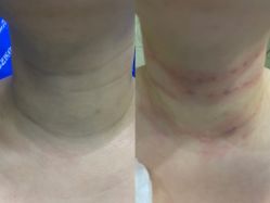 体验前-郡艺医疗美容·微整·眼鼻吸脂