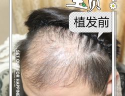 -大麦微针植发全国连锁