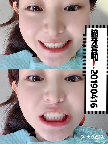 正畸328天：我终于摘牙套啦️️️