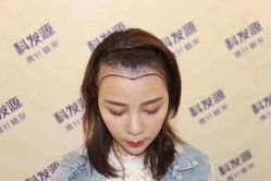 -大麦微针植发丨全国连锁