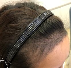 -大麦微针植发丨全国连锁