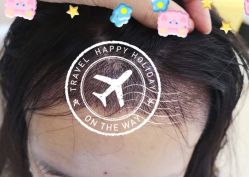 -大麦微针植发全国连锁