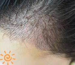 -大麦微针植发丨全国连锁