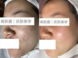 -美肤盾祛痘·问题肌头疗管理中心