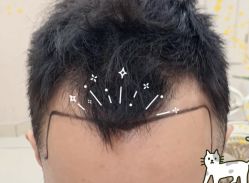 -大麦微针植发全国连锁