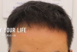 -大麦微针植发全国连锁