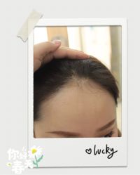 点击看大图 -大麦微针植发全国连锁