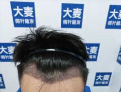 -大麦微针植发丨全国连锁