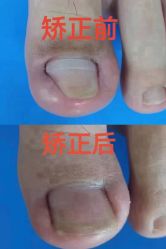 -德哥灰指甲脚气甲沟炎跖疣护理