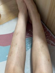 体验后-空军总医院激光整形美容中心