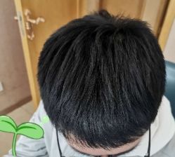 -大麦微针植发丨全国连锁