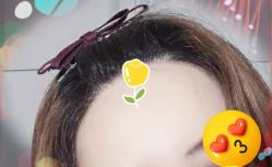 -大麦微针植发全国连锁