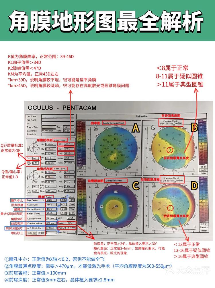 角膜地形图上看kappa角图片